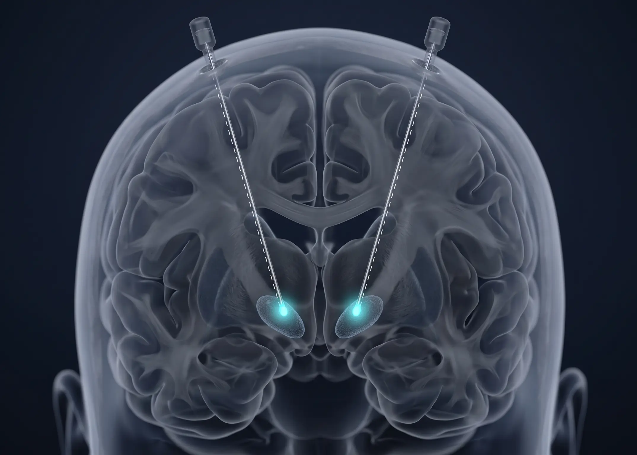 Neurocirurgia Funcional e Estereotáxica em São Paulo - Dr. Kléver Forte